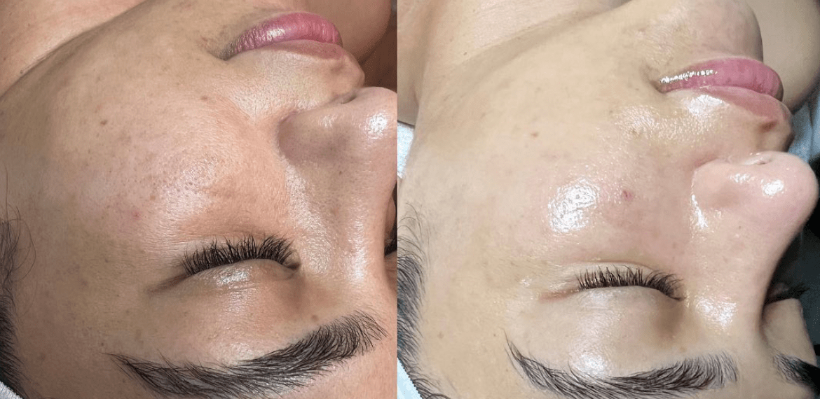 HydraFacial treatment room at Aura Skin-N-Beauty in Fremont, CA
